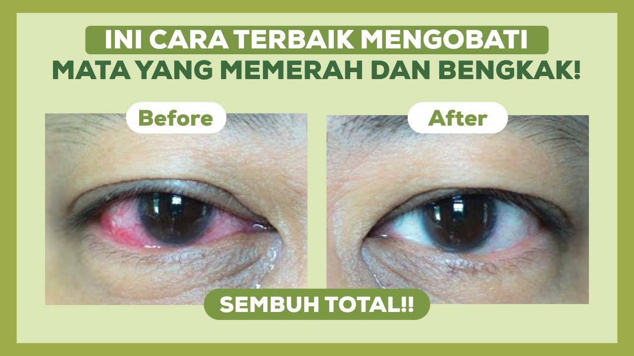 Mata Merah dan Bengkak? Jangan Panik! Ini Cara Cepat Mengatasinya!
