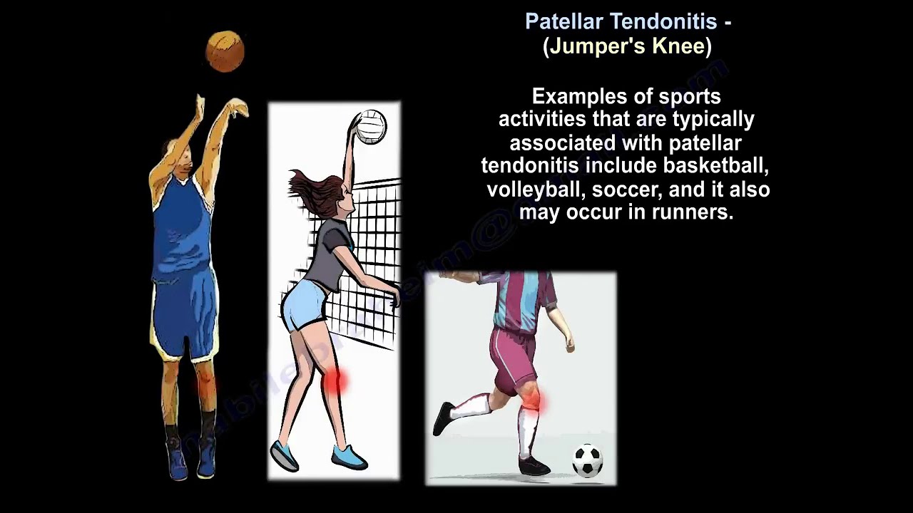 Patellar Tendonitis Jumper's Knee  - Everything You Need To Know - Dr. Nabil Ebraheim
