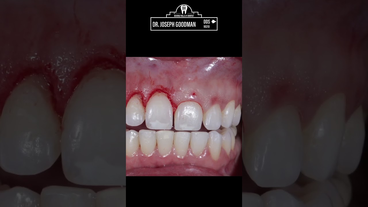 Gum Lift Before & After: Laser Gummy Smile Treatment in Beverly Hills | Dr. Joseph Goodman