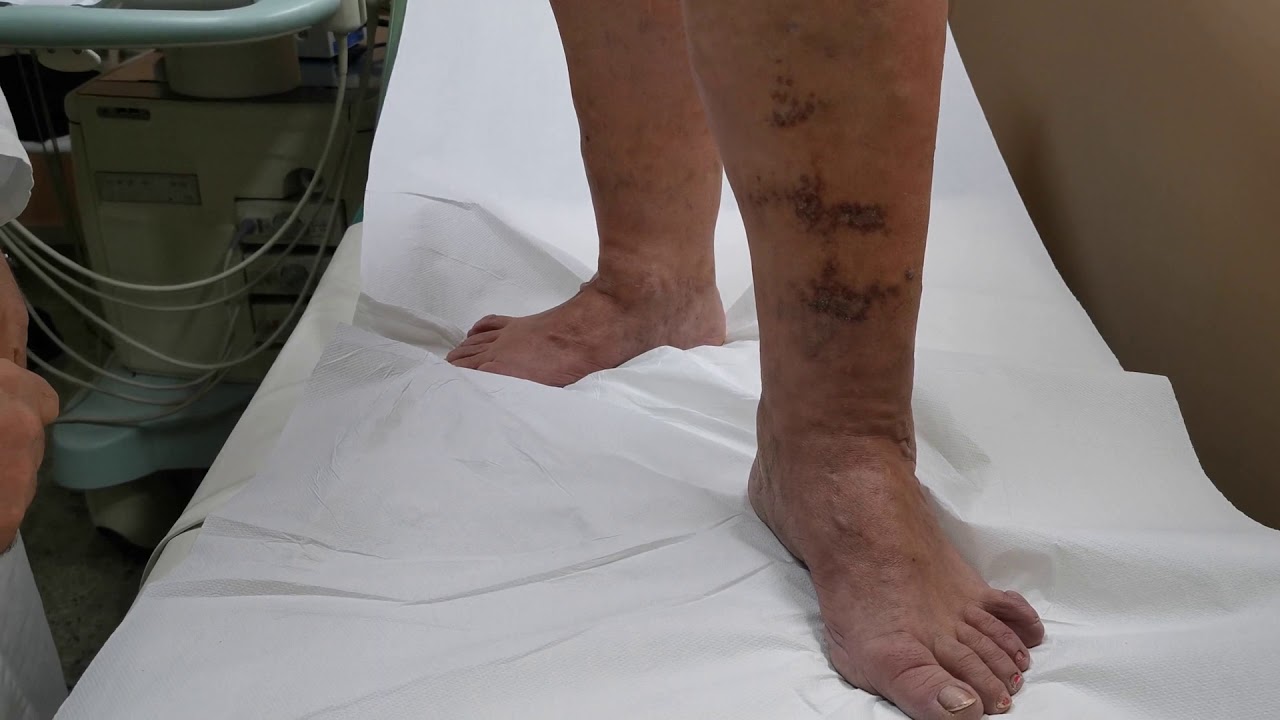 VARICI TRATTATE CON LASER ENDOVENOSO E ''COLLA BIOLOGICA''