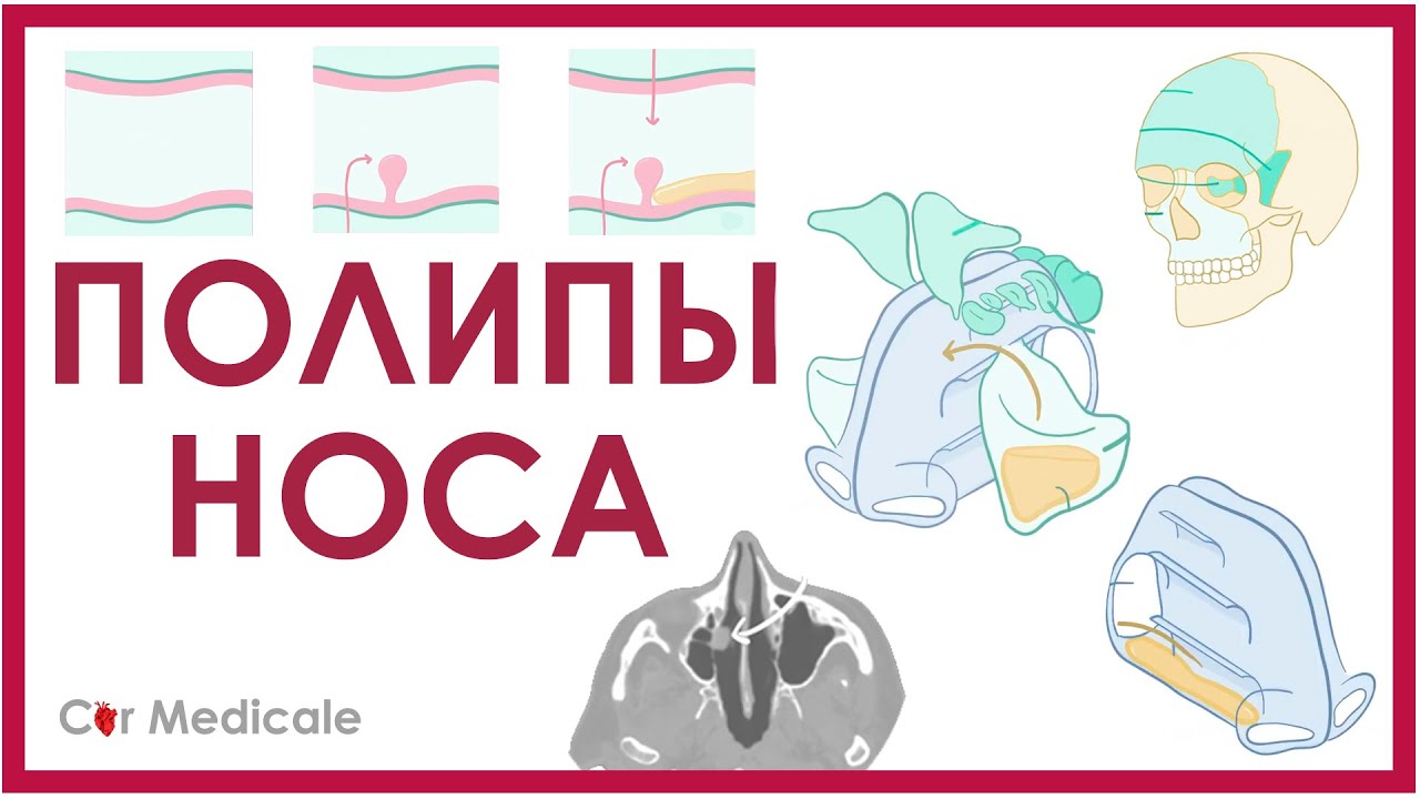 Полипы носа - что такое, причины, методы лечения - кратко