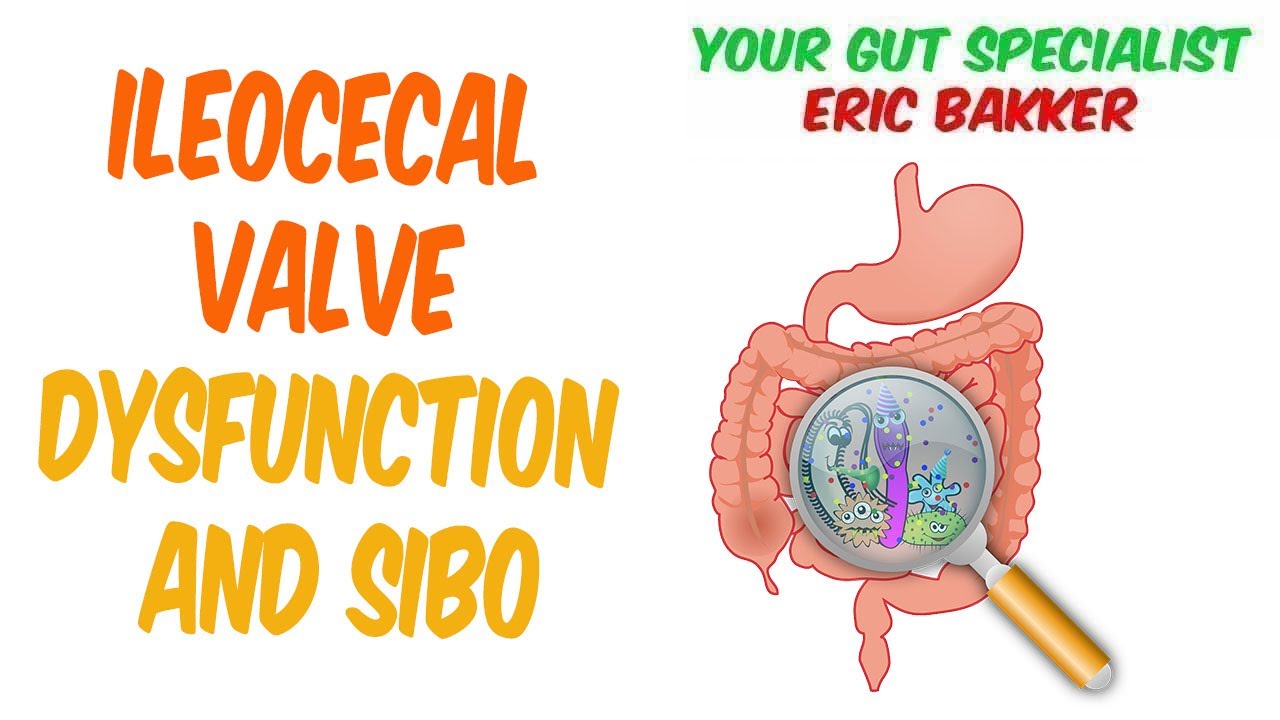 Ileocecal Valve Dysfunction And SIBO