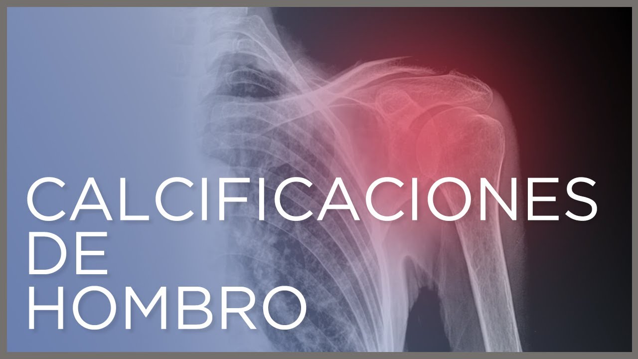 Calcificaciones de hombro: qué es y cómo se tratan