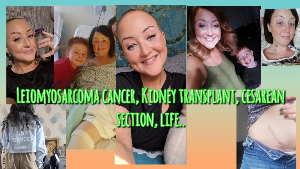 It's been tough, it's been beautiful! - Leiomyosarcoma terminal cancer & kidney transplant recipient