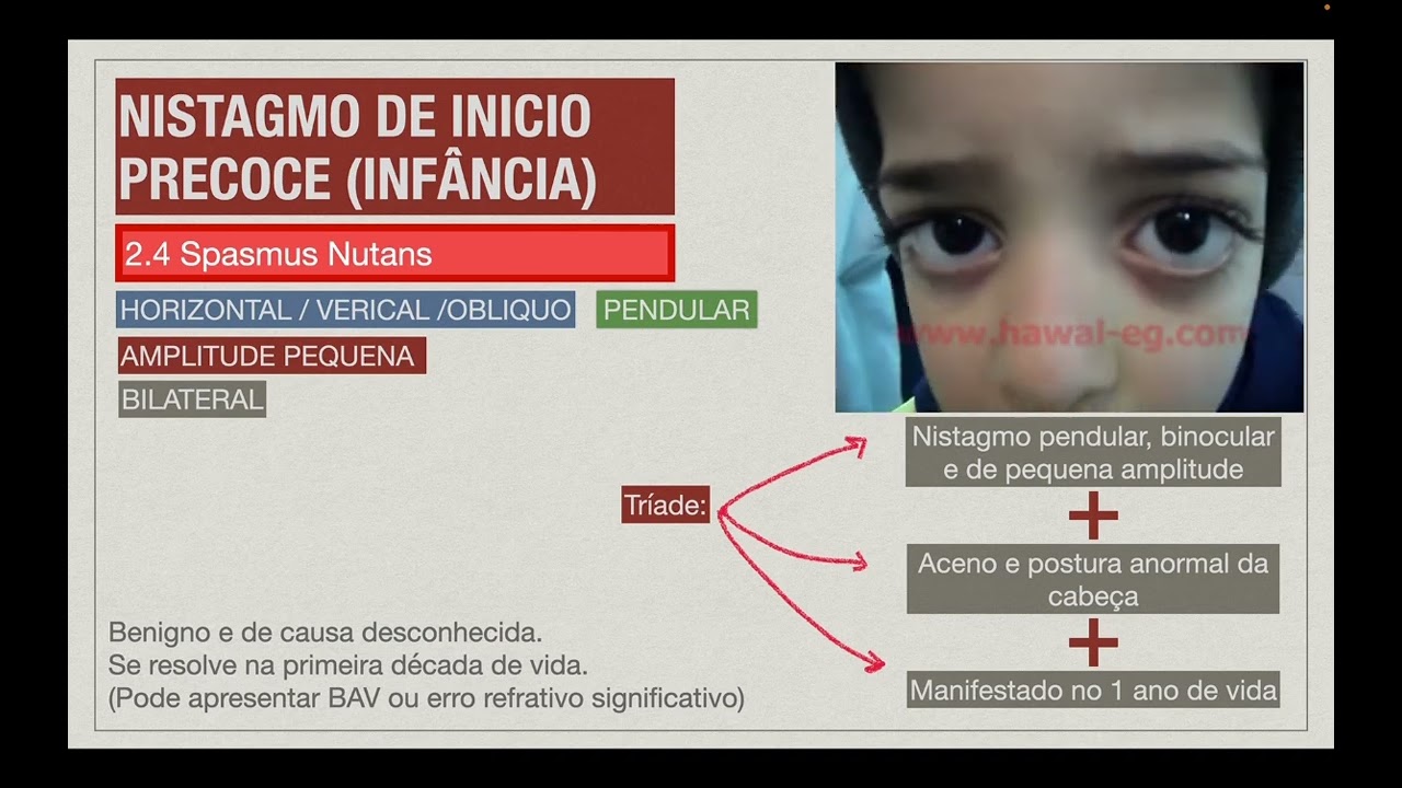 AULA 13  - programa estrabismo - NISTAGMOS