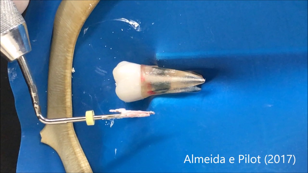 Técnica de Ondas Contínuas de Obturação