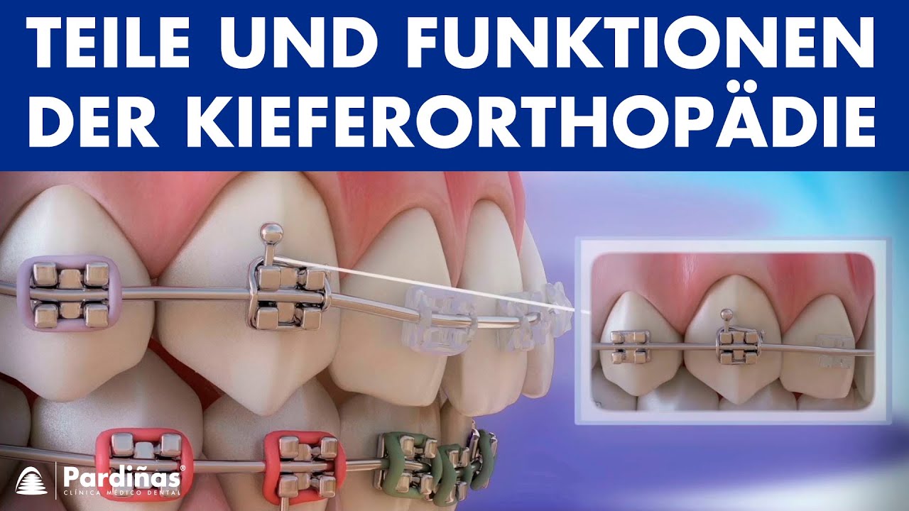 Kieferorthopädie – Teile und Funktionen der Zahnspange ©