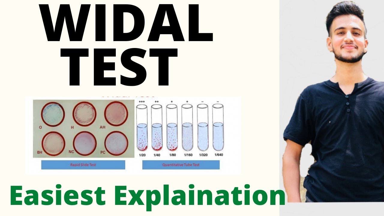 Widal Test in Hindi / Widal Test procedure / Widal Test