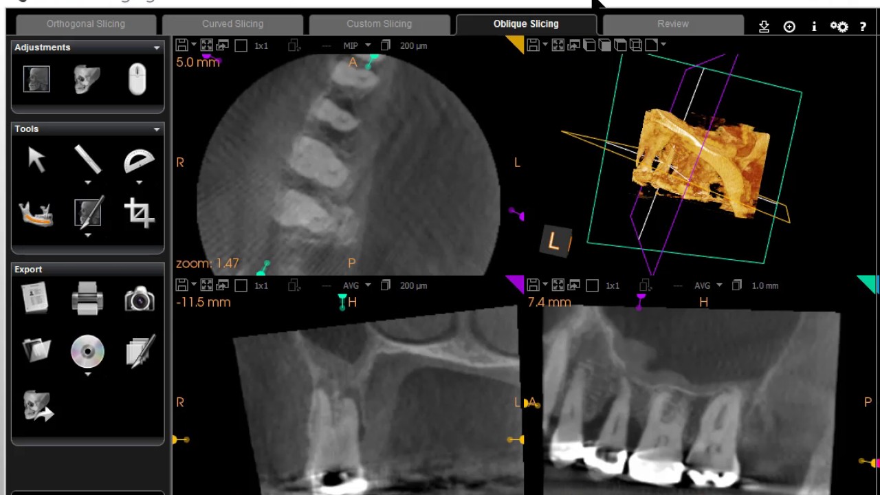 cracked tooth detection cbct
