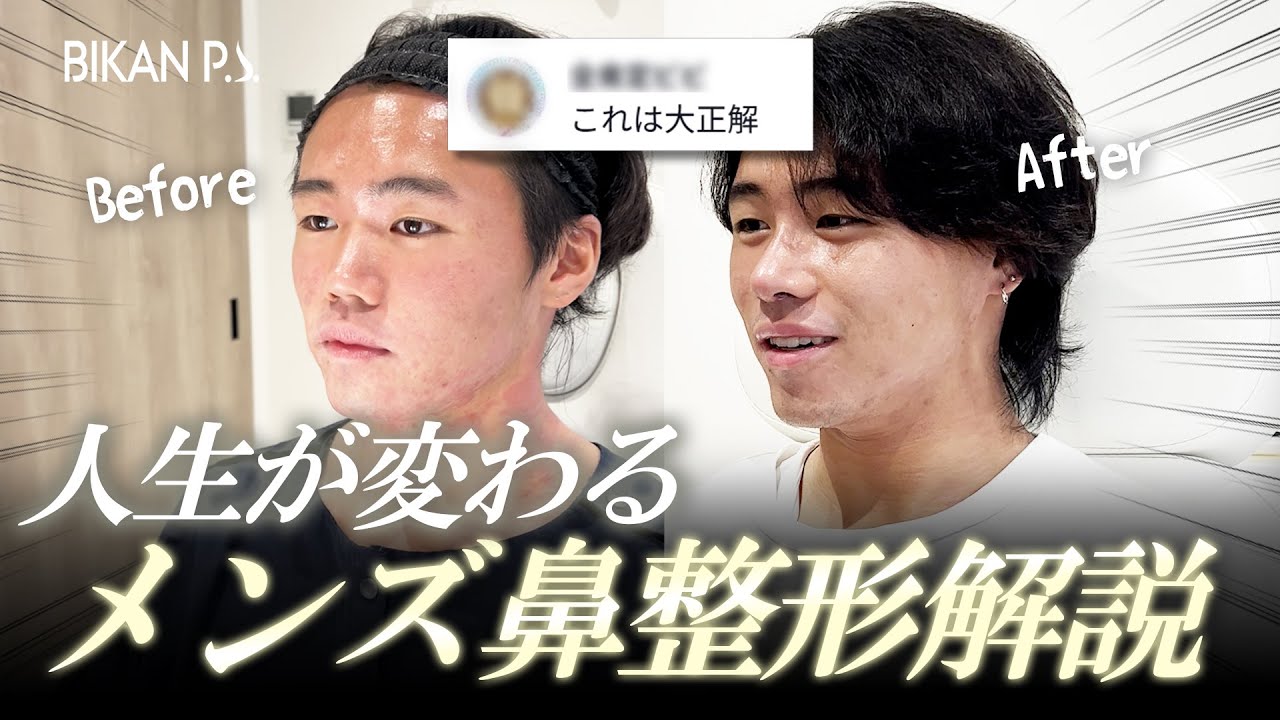 【鼻整形】これは人生変わる！ネットで大バズりしたメンズ鼻整形、その成功の理由を徹底解説！