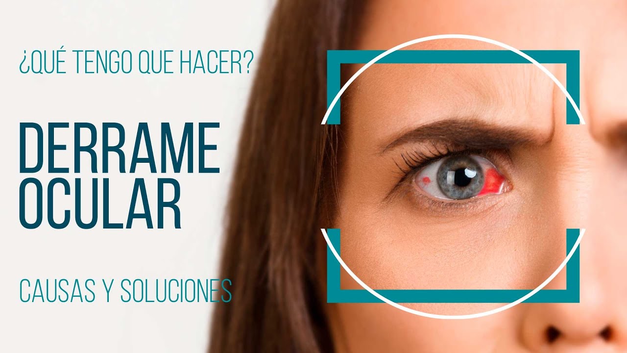 DERRAME EN EL OJO ¿Qué tengo que hacer?