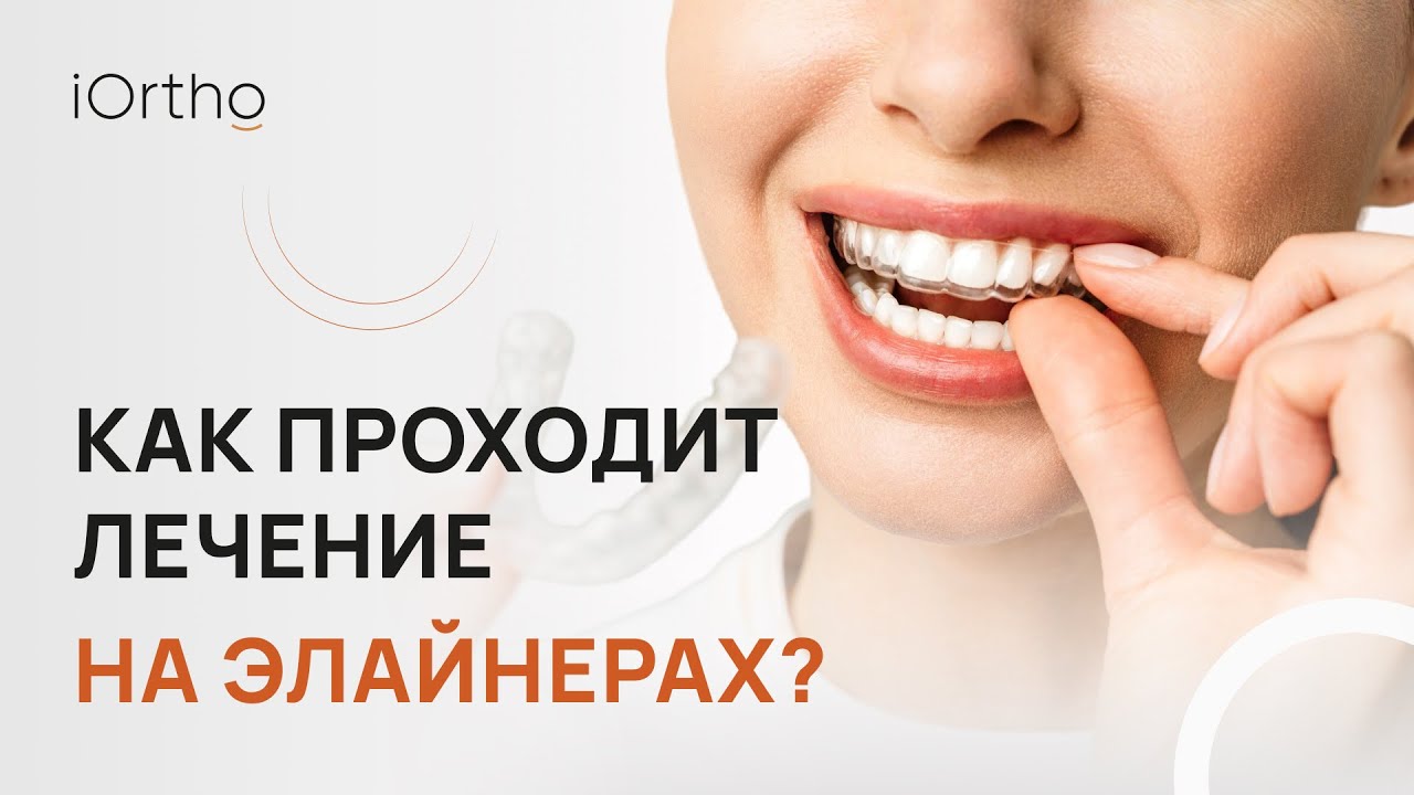 👉 Как проходит лечение на элайнерах