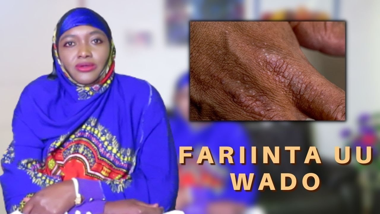 WAA MAXAY FARIINTA UU NOOWADO MAQAARKA QALALAN? SOO AFJAR AKNE, FIMMANKA, KADKADUUDKA IYO HAARAHA!