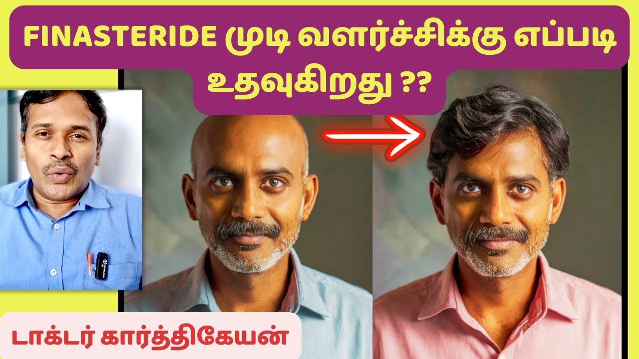 இந்த முடிவளர்ச்சி சாத்தியமா? | Finasteride Hair loss treatment