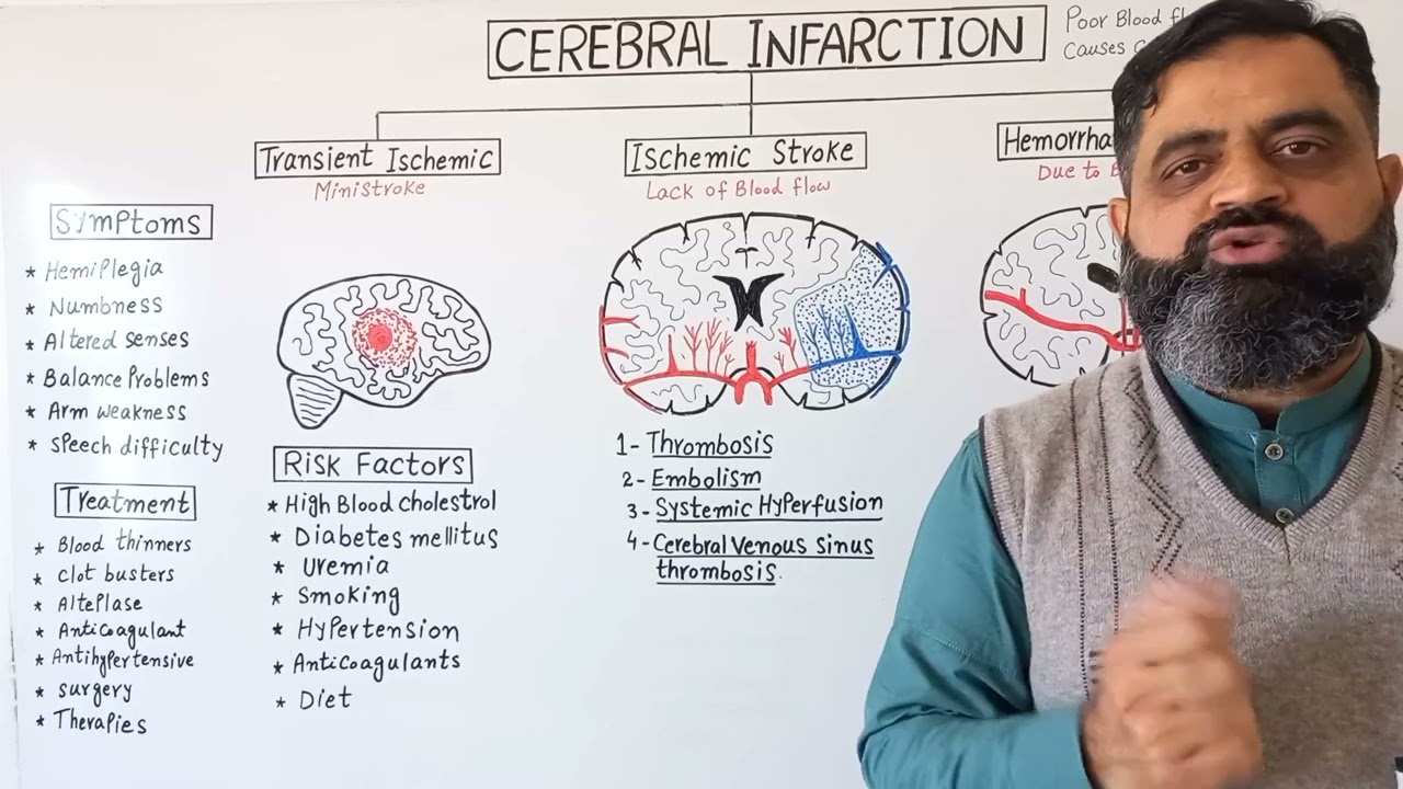 Stroke Urdu/Hindi medium @prof.masoodfuzail| Cerebral Infarction | Types of Stroke | Brain Stoke