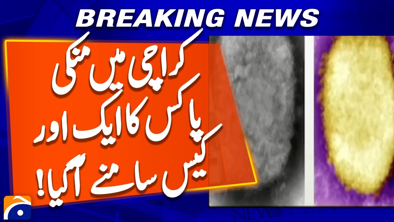 Another case of monkeypox has come to light in Karachi | Geo News