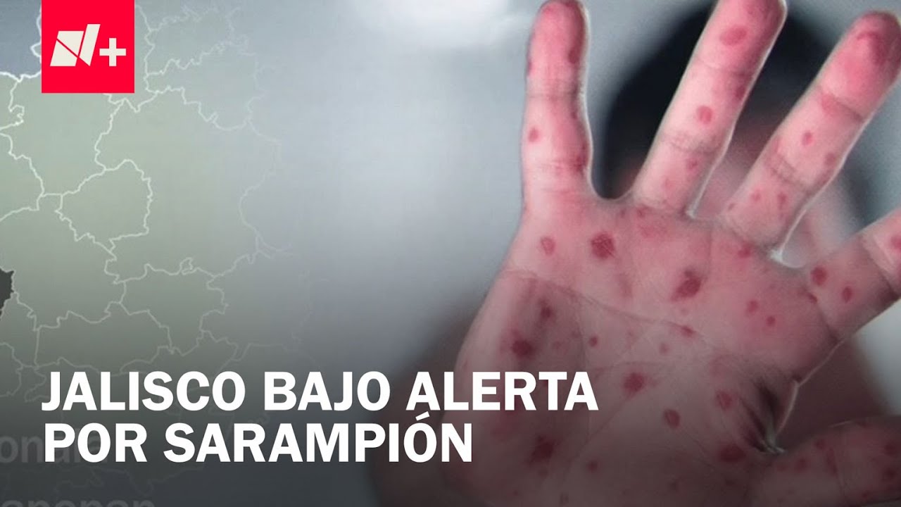 Sarampión en México: El Virus Está de Vuelta en Jalisco y Siguen Aumentando los Casos