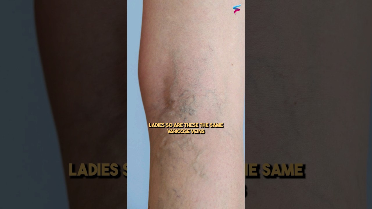 Varicose Veins or Reticular Veins? #shortfeed #veinspecialist #spiderveins