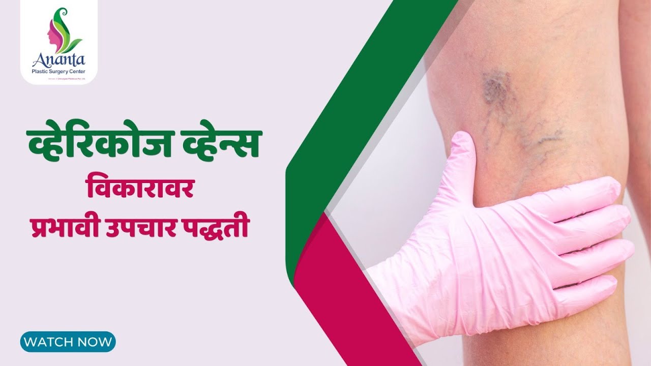 व्हेरिकोज व्हेन्सवरील उपचार... #vericoseveintreatment #vericoseveins #plasticsurgeon #plasticsurgery