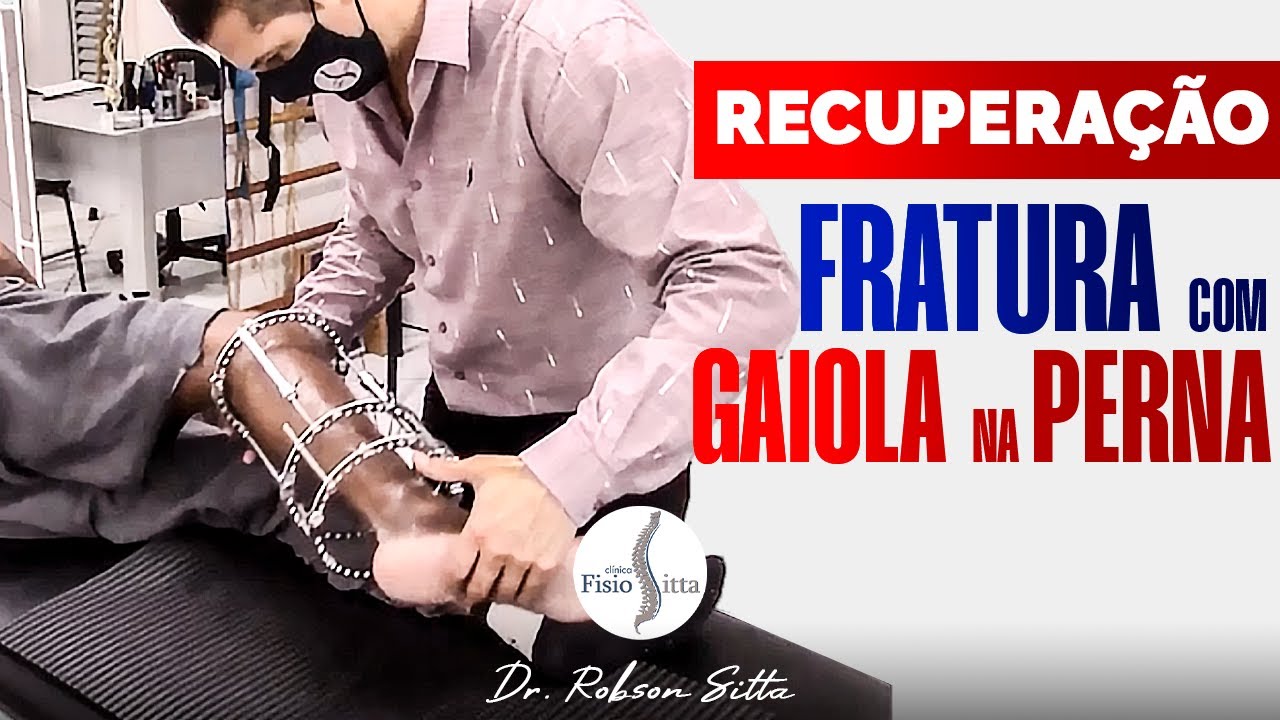 RECUPERAÇÃO FRATURA do PILÃO TIBIAL com FIXADOR EXTERNO de ILIZAROV na FISIOTERAPIA Dr. Robson Sitta