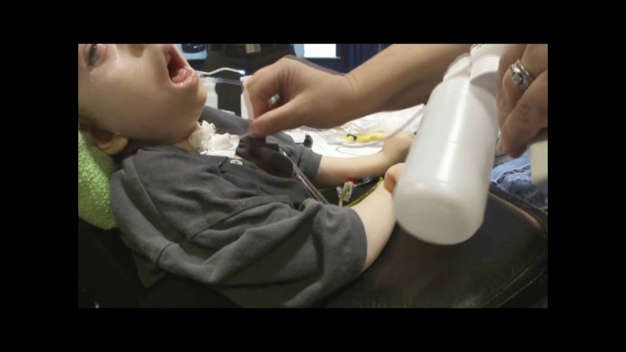 RES-Q-VAC with a Tracheostomy Patient