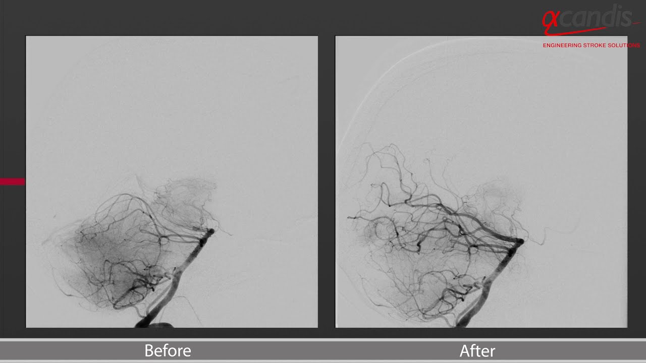 Mechanical thrombectomy with APERIO® Hybrid17 Thrombectomy Device