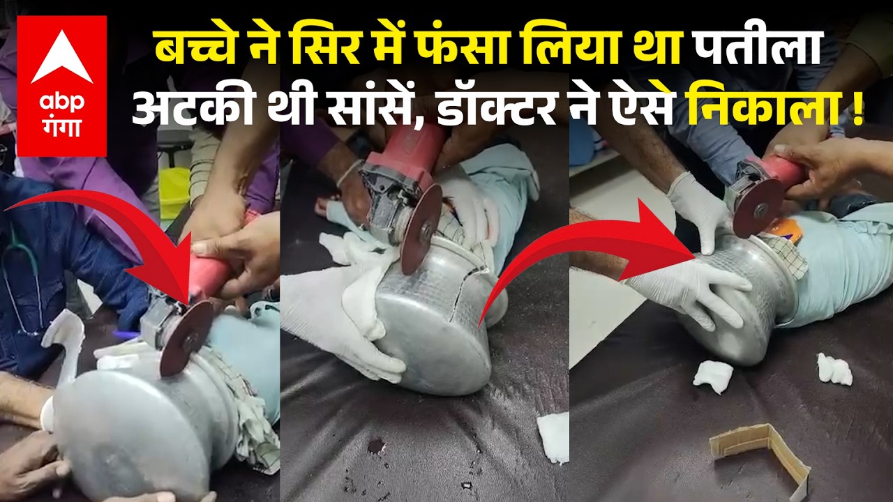 Viral Video: खेलते समय मासूम बच्चे के सिर में फंसा एल्युमिनियम का बर्तन, बच्चे की जान पर बन आई !