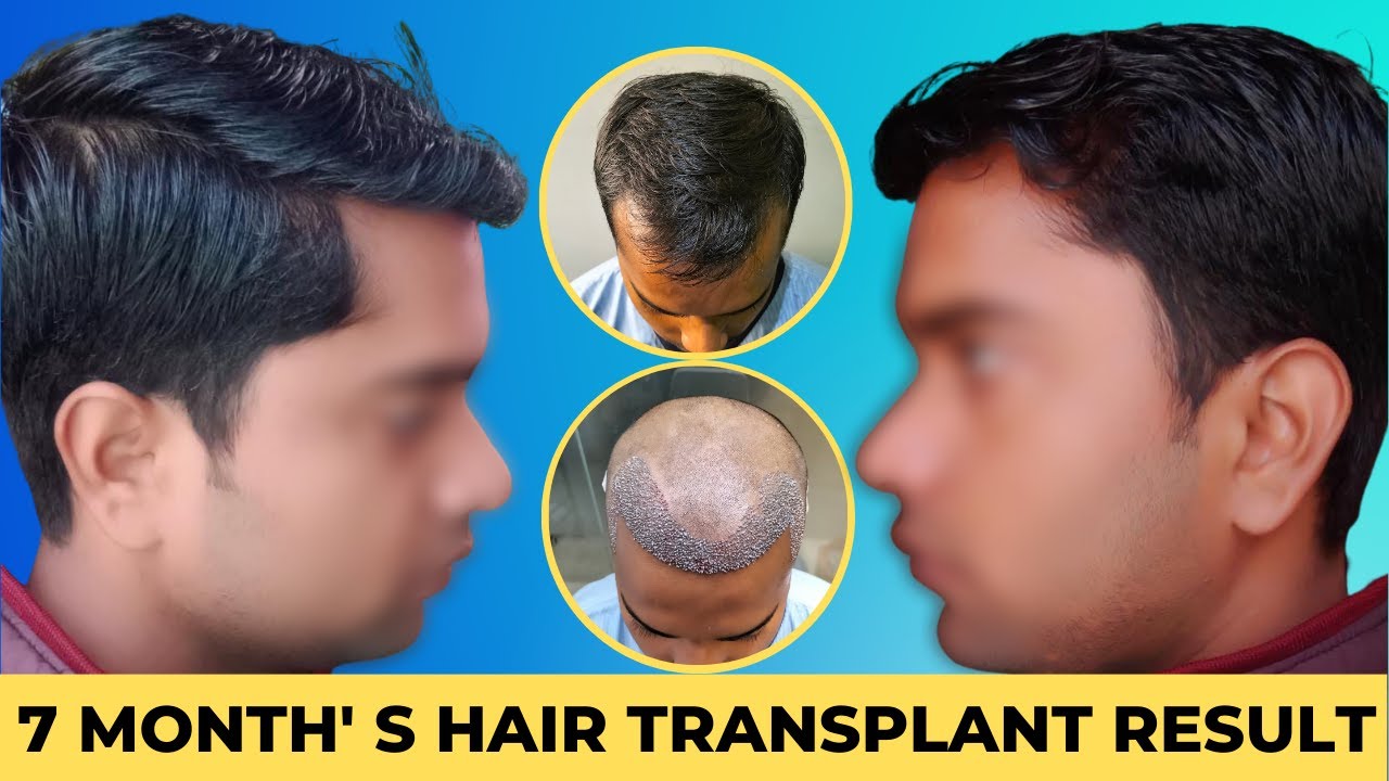 Hair Line Hair Transplant || Receding Hairline || Hair Transplant Result 7 Months || 2600 Grafts