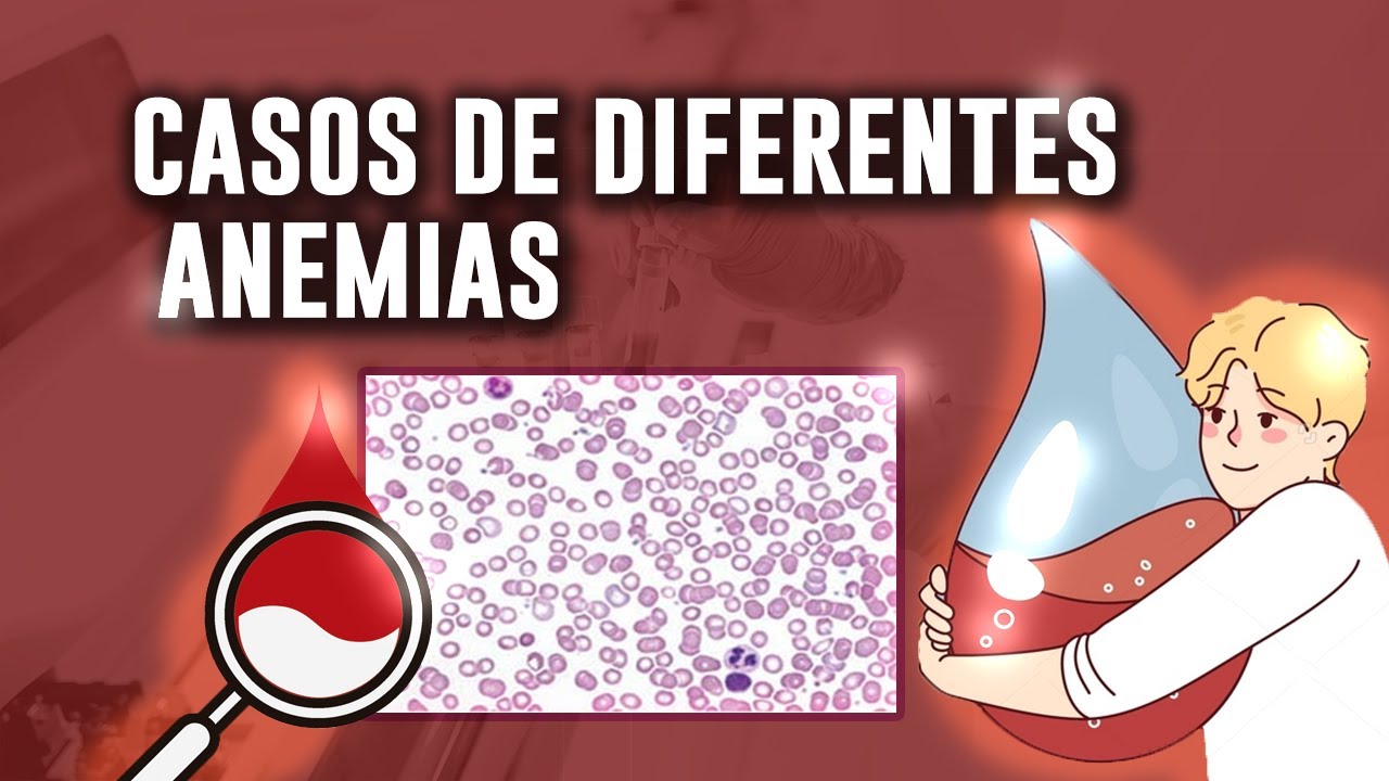 ¿Cómo se observan los FROTIS de SANGRE de pacientes con ANEMIA? | Casos y células encontradas