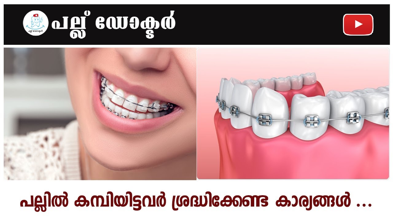 പല്ലിൽ കമ്പിയിട്ടവർ ശ്രദ്ധിക്കേണ്ട കാര്യങ്ങൾ ...