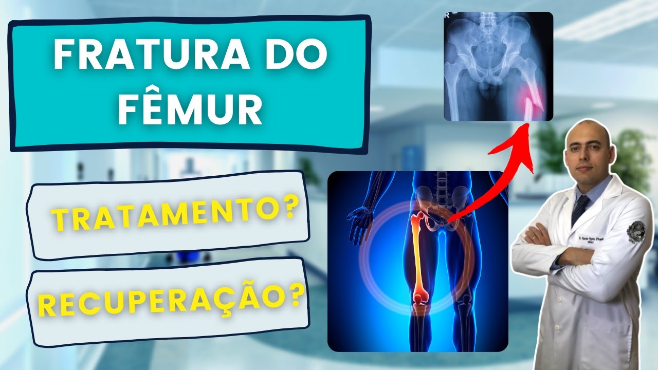 FRATURA DE FÊMUR: COMO É A CIRURGIA E RECUPERAÇÃO?
