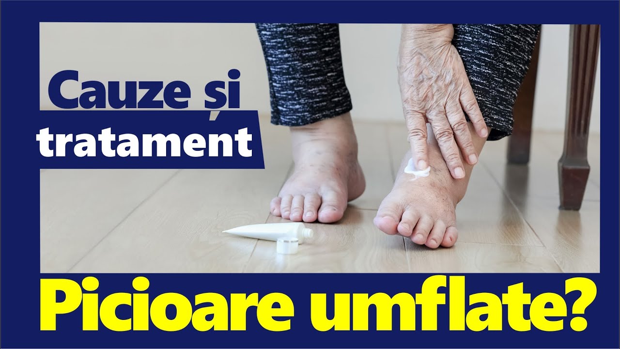 Picioare UMFLATE? Cauze și Tratament