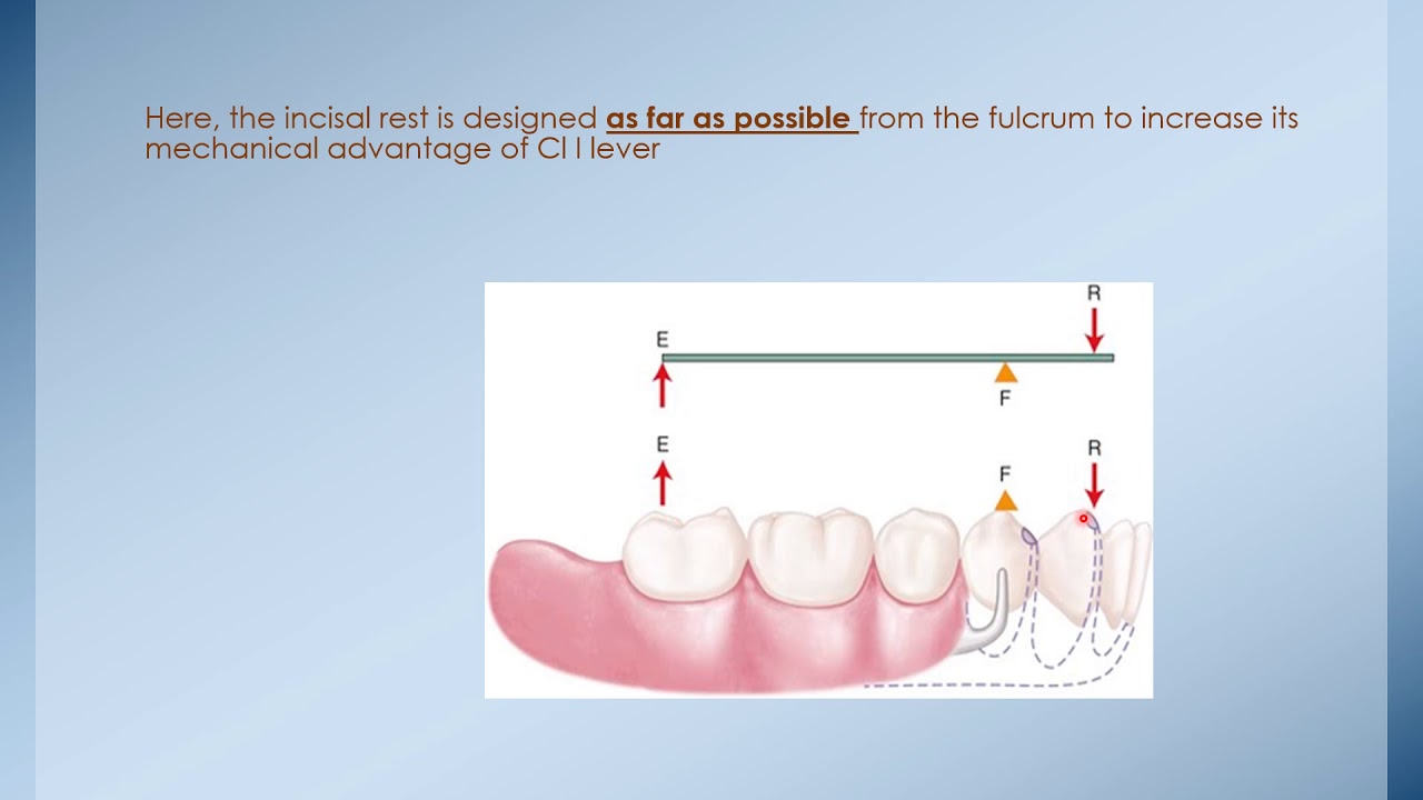 Principles of RPD Design