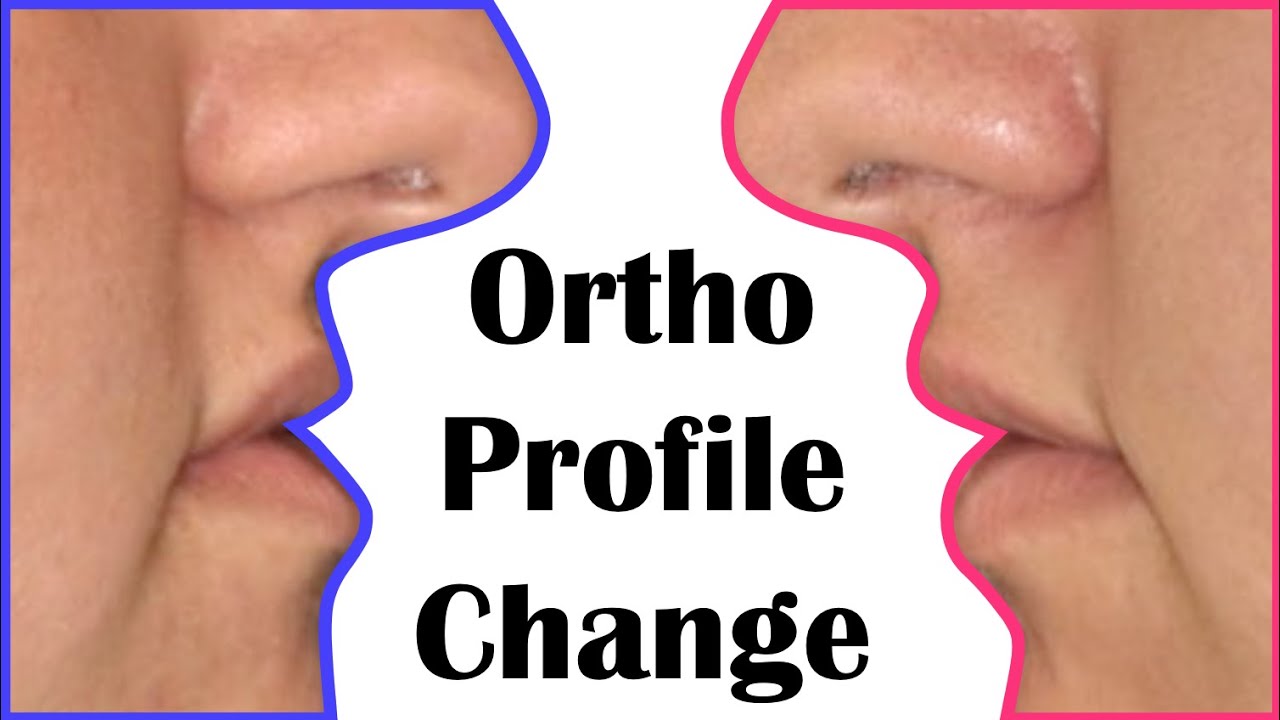 Skeletal open bite treatment and orthodontics braces - treatment lecture