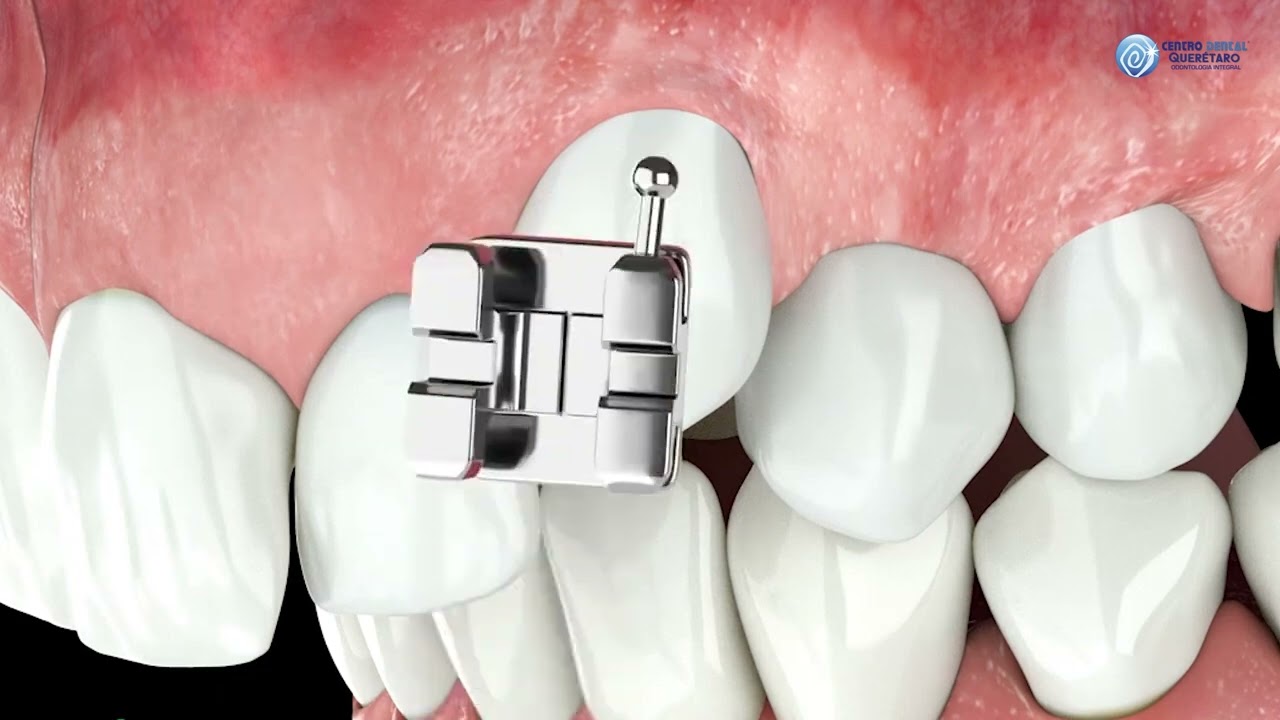Ortodoncia | Brackets de Autoligado | Centro Dental Querétaro