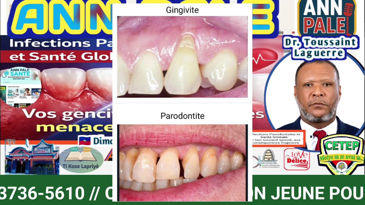 ANN PALE 🇭🇹  
 ABONE, LIKE, PATAJEL AK FANMI 🇭🇹 INFECTION PARODENTALES ET SANTÉ GLOBAL 🇭🇹