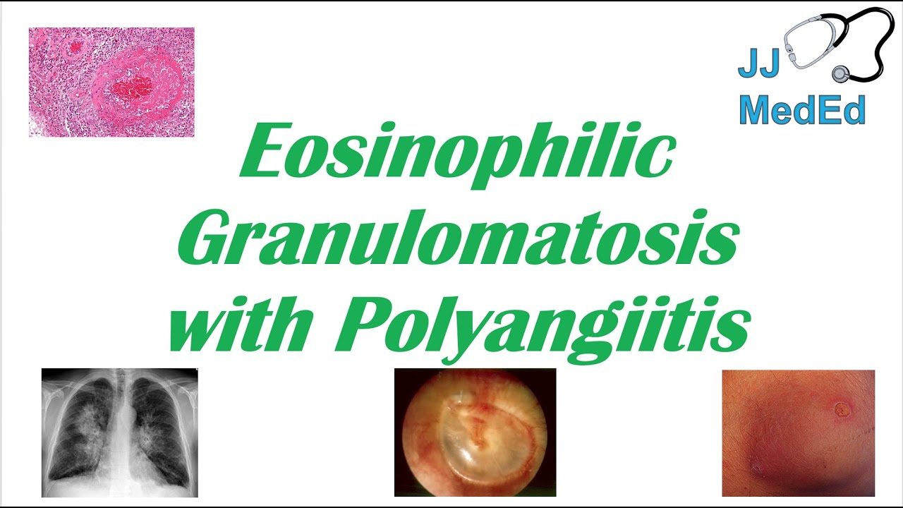 Eosinophilic Granulomatosis with Polyangiitis (EGPA) | Churg-Strauss Syndrome, Autoimmune Vasculitis