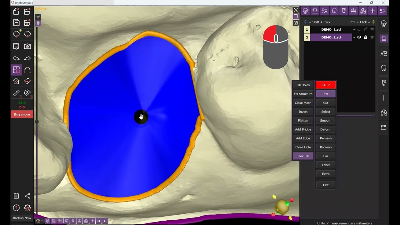 Virtual Teeth Extraction in ImplaStation