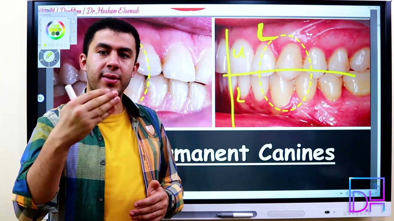 21- Maxillary Permanent Canine P1