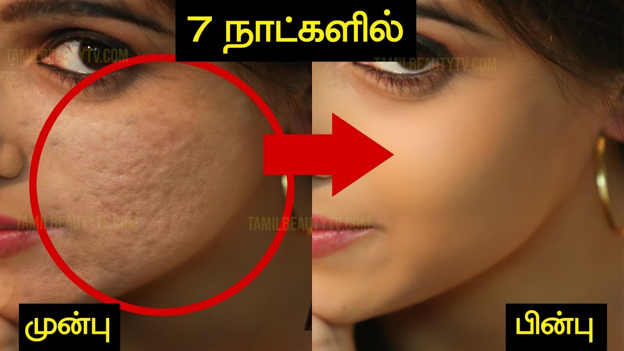 Treatment for Large Pores /  Open Pores - Tamil Beauty Tv