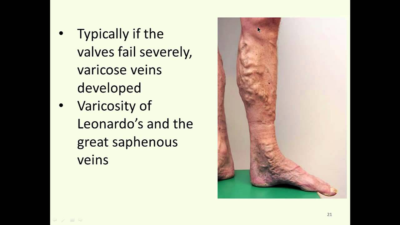 Deep Venous System Anatomy & Chronic Venous Insufficiency