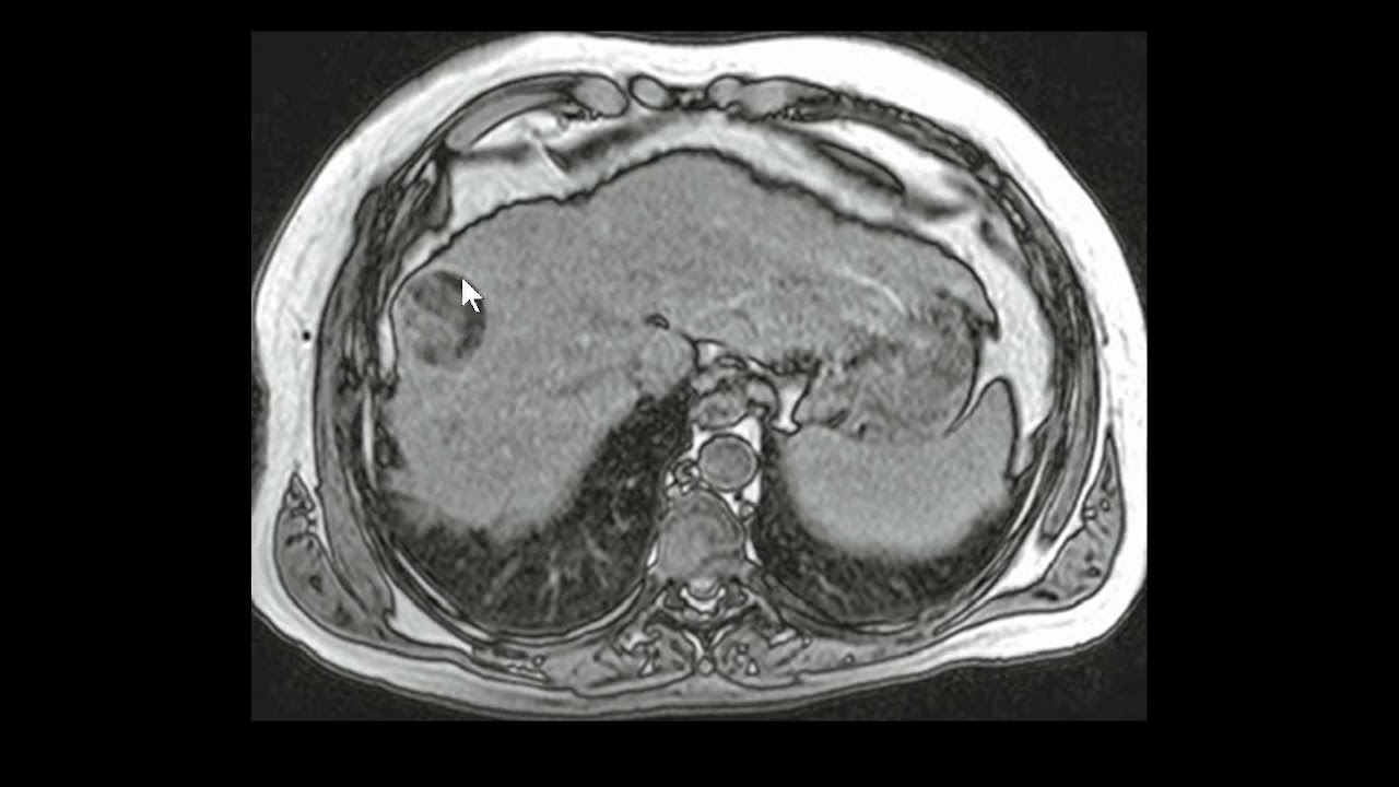 Hepatocarcinoma