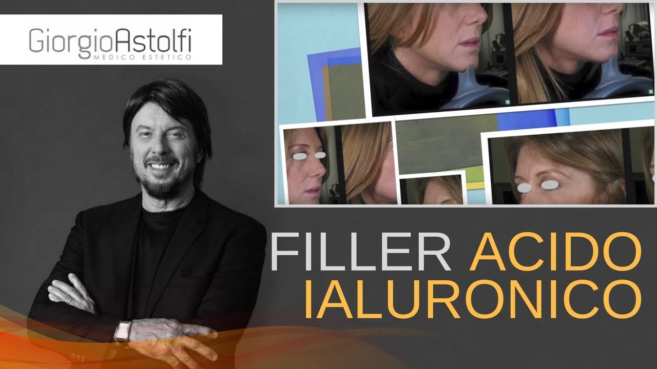 Filler Acido Ialuronico Prima e Dopo