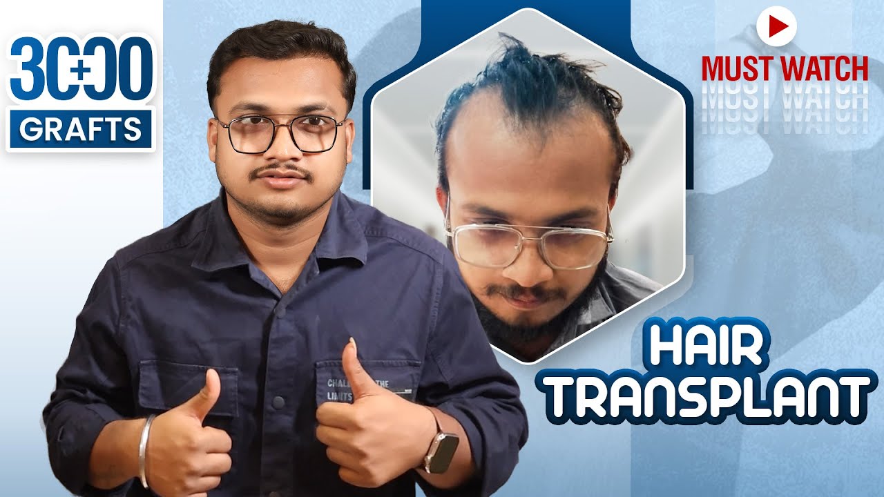 Grade 3 Hair Transplant Result | 3000 Grafts BIG-FUE | Hairfree & Hairgrow Nagpur