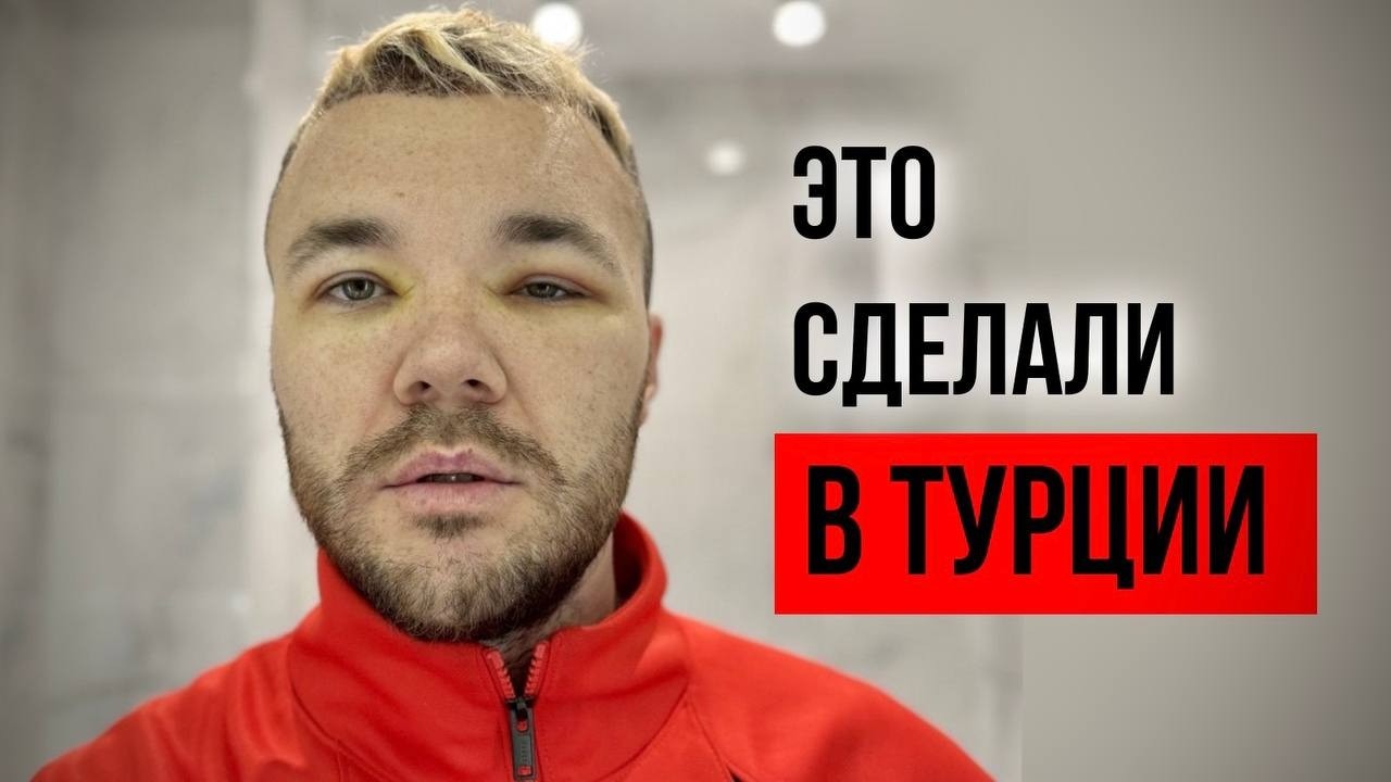 Пересадка волос в Турции. Моё путешествие в боль / СТАМБУЛ