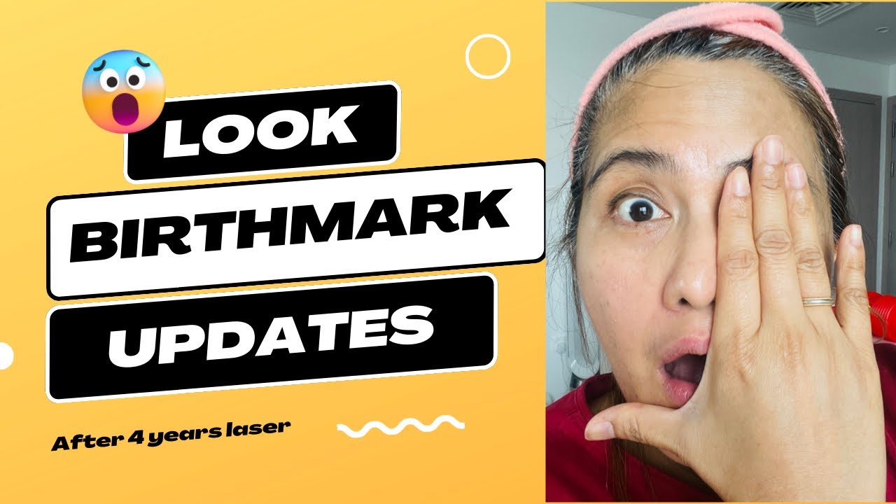 Look! My birthmark after 4 years of laser removal | Birthmark Removal | Nevus of Ota