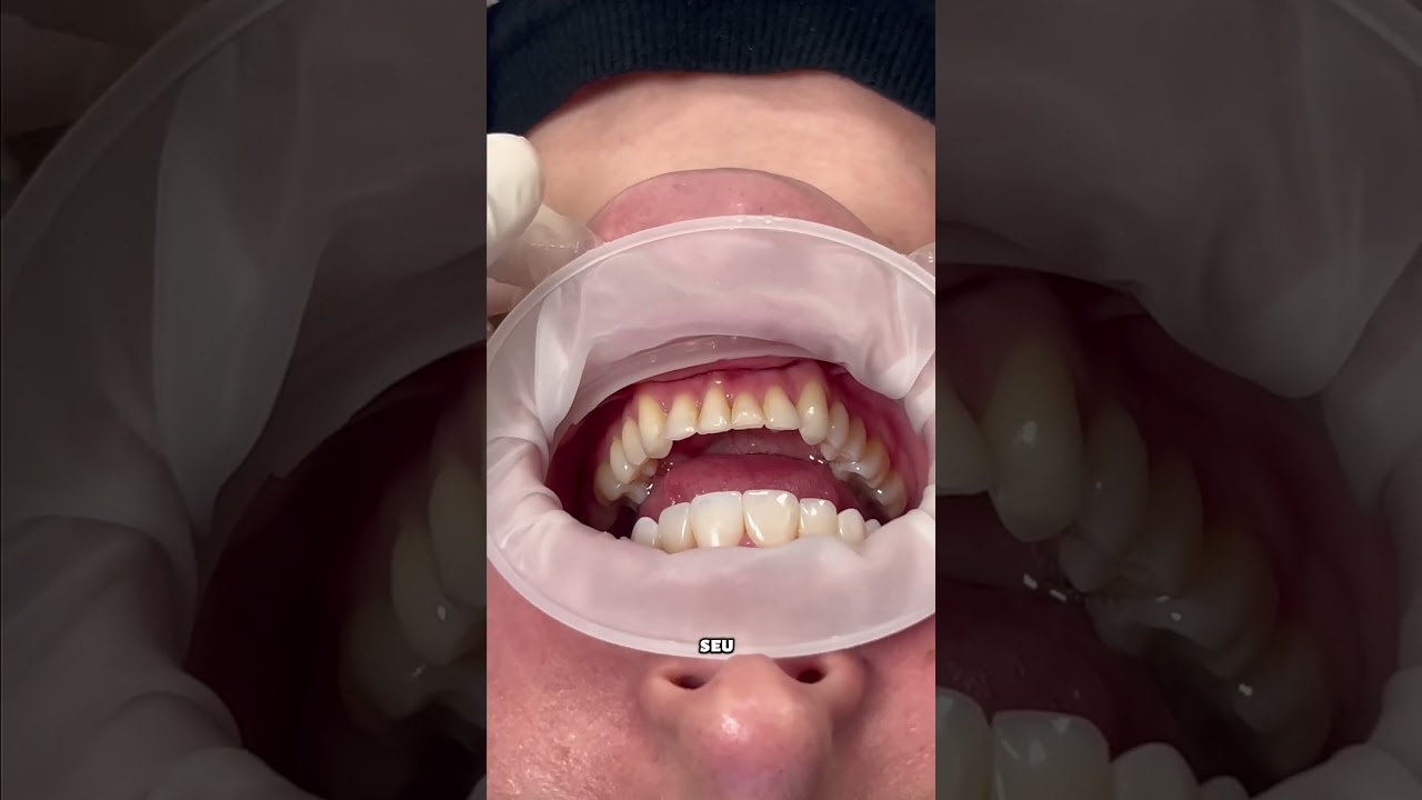 Optragate: o melhor afastador labial 