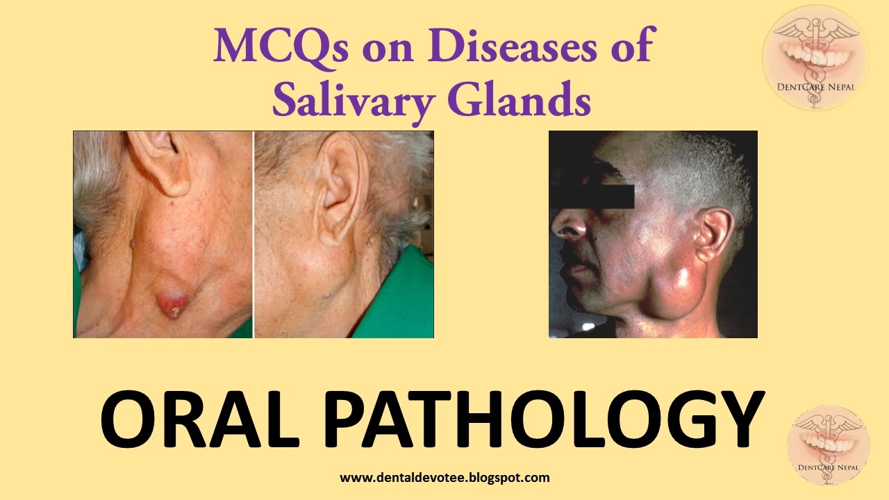 Oral Pathology MCQs - Diseases of Salivary Glands