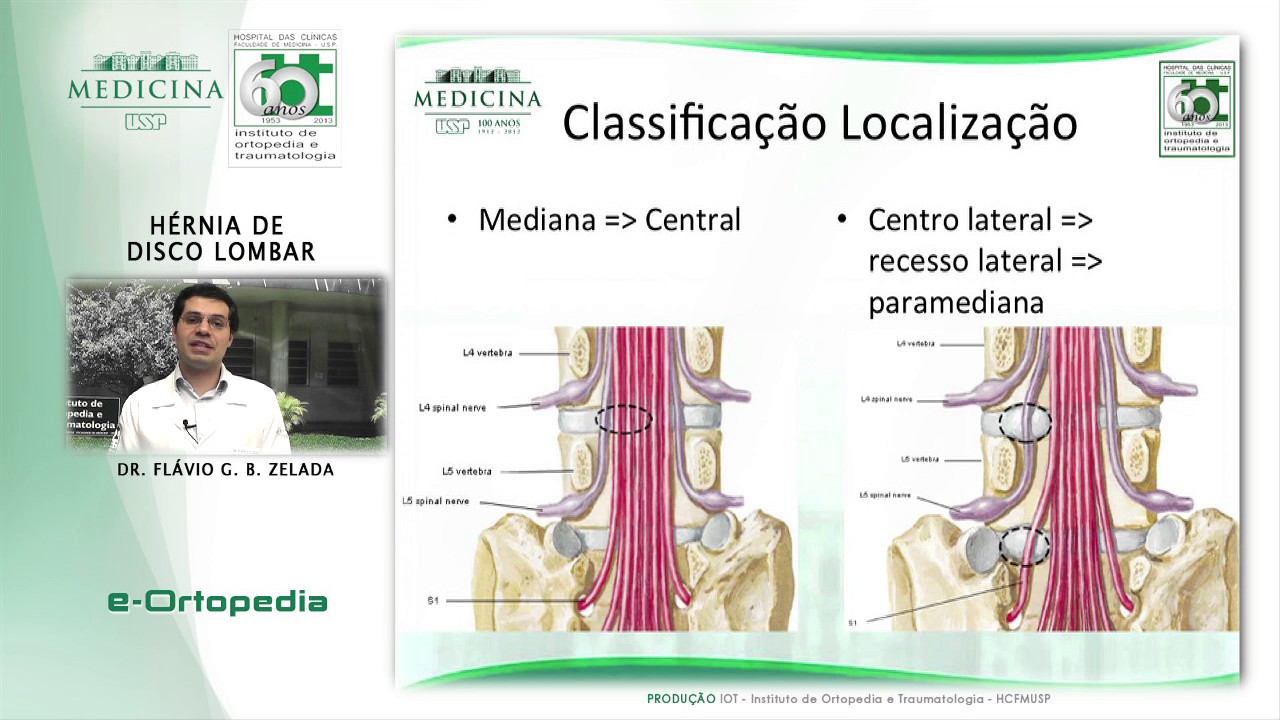 Hérnia de Disco Lombar - Dr. Flávio G.B. Zelada