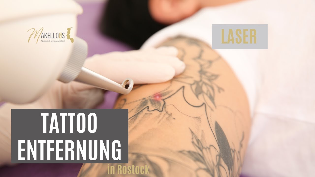 &Auml;rztliche Laser TattooEntfernung & PMU Entfernung mit dem Laser bei Makelloos in Rostock Dr Teichert